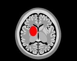 Intracerebral haemorrhage CT
