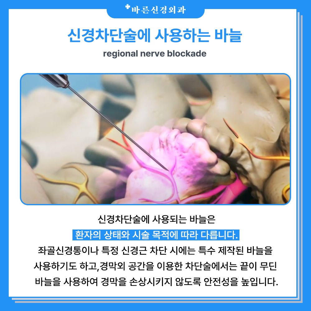 신경 차단술