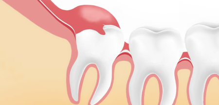 Wisdom Teeth Removal Cost Wisdom-Teeth-Removal-Cost