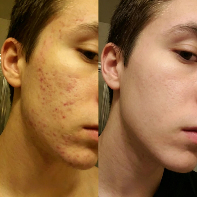 Jake R before and after result