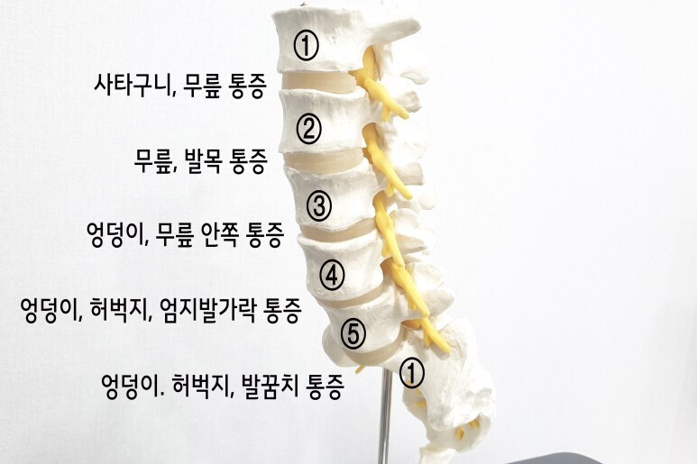 발바닥통증의 원인 디스크
