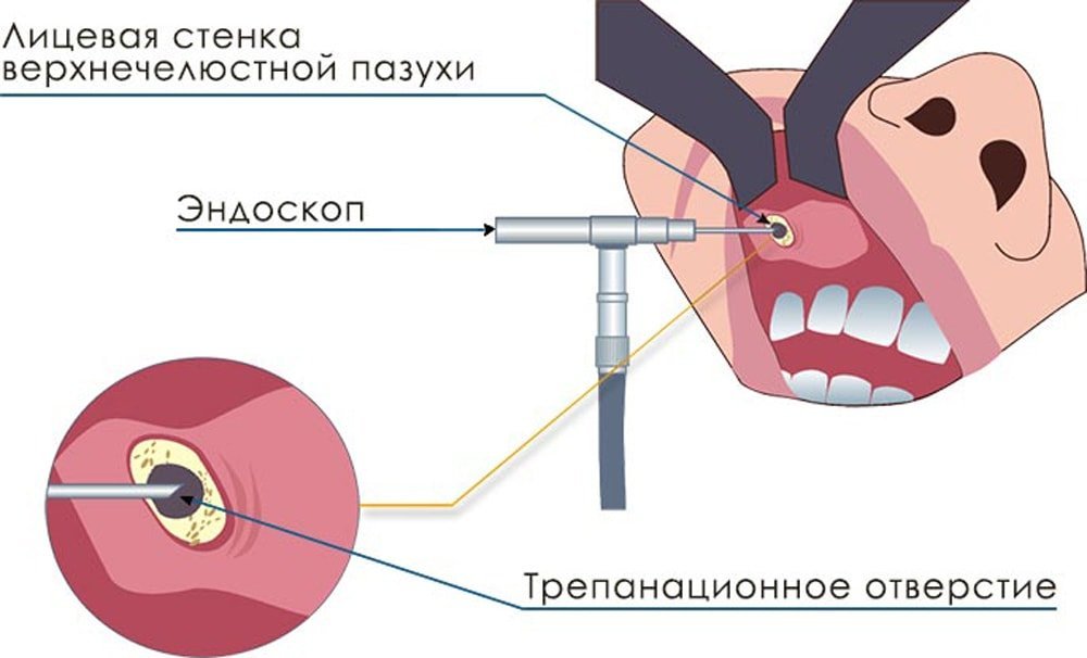 Микрогайморотомия