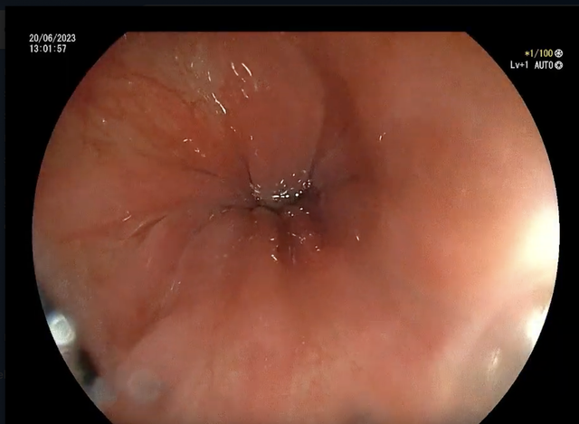 gastroscopy