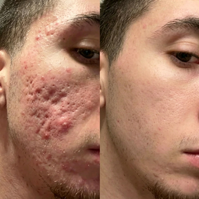 Nina R before and after result