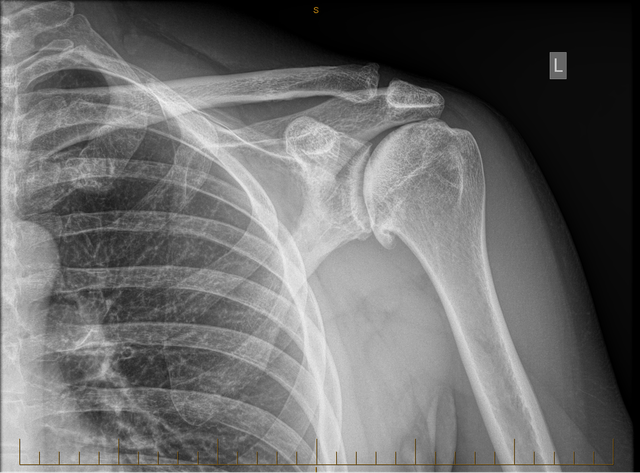 Left-Shoulder