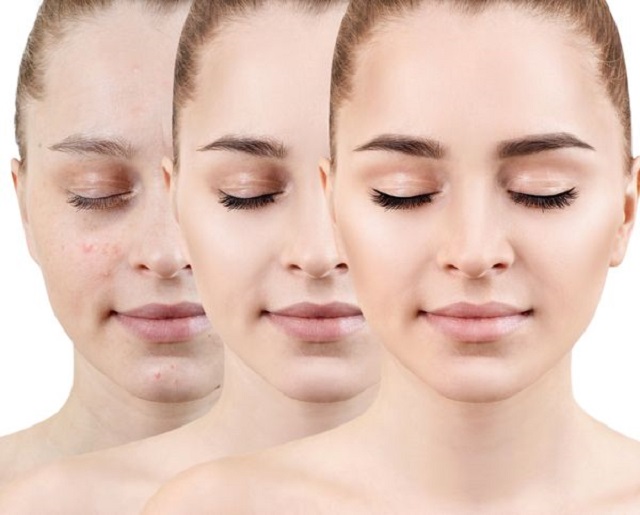Acne.jpg
