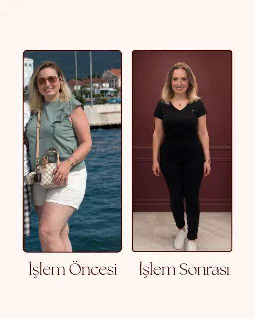 G5 Öncesi Sonrası 2