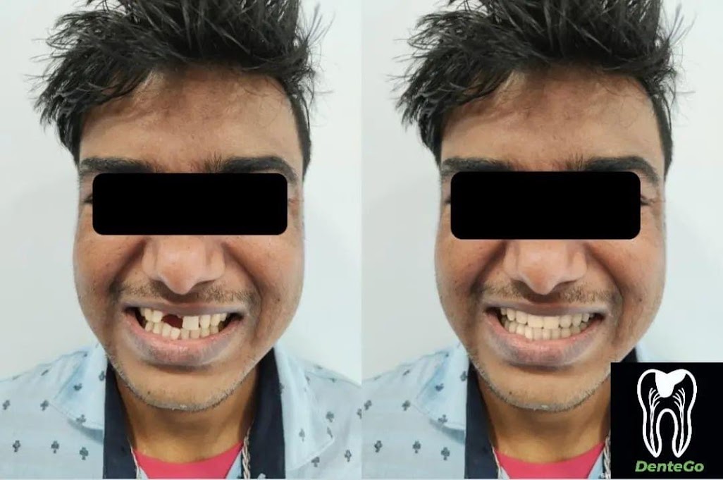 Restorative Dental Treatment at DenteGo