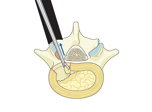 Tubular MIS discectomy