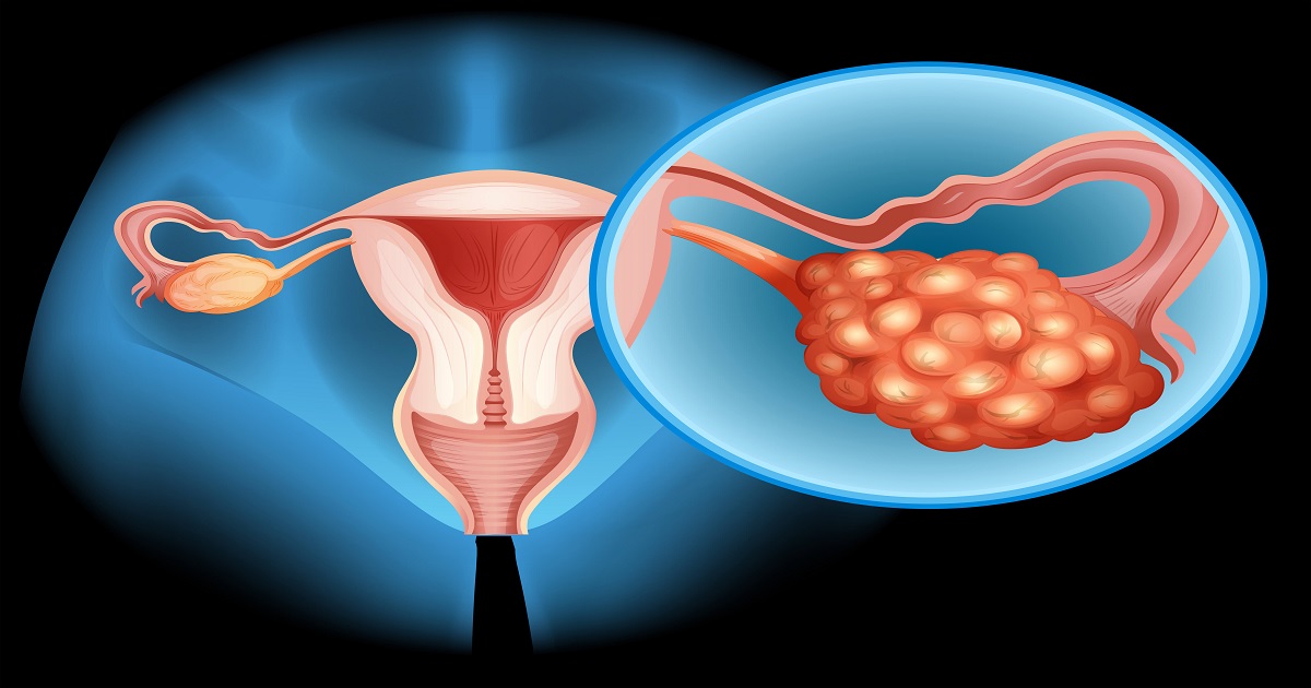 PCOS and PCOD hormone-balancing nutrition