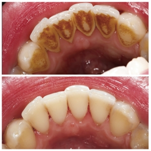 Professional Teeth Cleaning