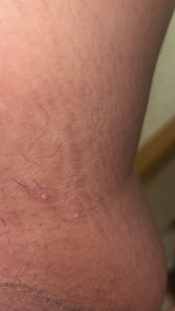 painless bumps on inner thigh